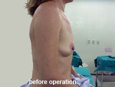 plastic-surgery-breast-augmentation 
